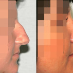 operacja nosa poznań