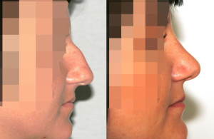 operacja nosa poznań