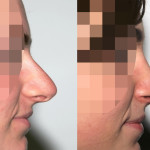 operacja nosa w poznaniu